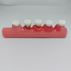 Parodontitis Studiemodel 